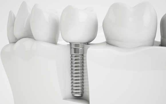 Implant Dentistry